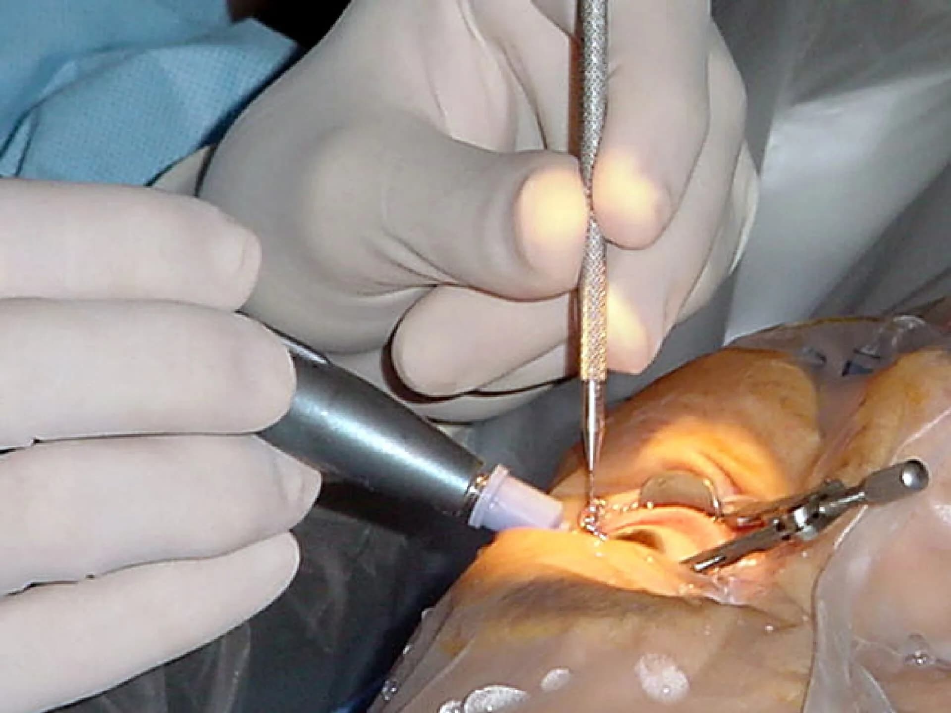 Phaco cataract surgery care at Eye First Superspeciality Eye Care